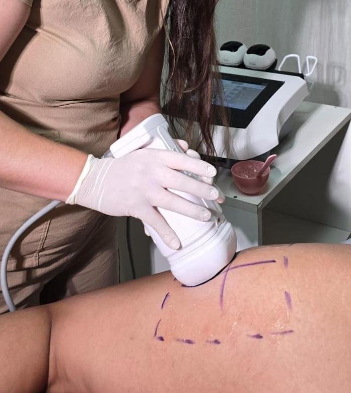 LIPOSONIX - LIPO HIFU Corporal ¨(1 zona)